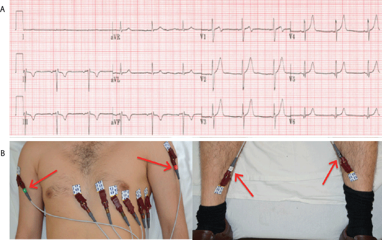 abnormal 12 lead ecg