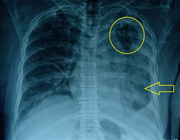 Chest X-ray Showing Cavitary Lesion (shown by a Circle) and Consolidation in the Left Lung (shown by an Arrow).