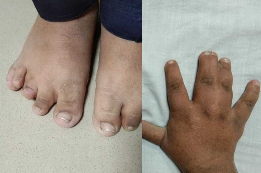Polydactyly and Syndactyly 