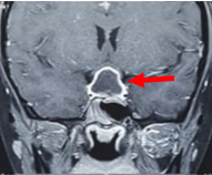 The image titled "MRI Brain Coronal Study Showing Sellar Mass with Suprasellar Extension Causing Optic Chiasm Compression" presents a coronal MRI scan that reveals a mass in the sellar region, extending into the suprasellar area. The red arrow points to the lesion compressing the optic chiasm, a critical structure responsible for vision. This finding is consistent with the diagnosis of a sellar tuberculoma, a rare condition that can mimic pituitary tumors, leading to both visual disturbances and hormonal dysfunction​.