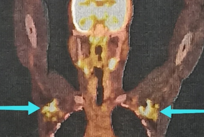 Positron Emission Tomography with Computed Tomography Showing Metabolically Active Axillary Lymph Nodes (Blue Arrow). It was Done After Malignancy was Suspected to Determine the Extent of Spread