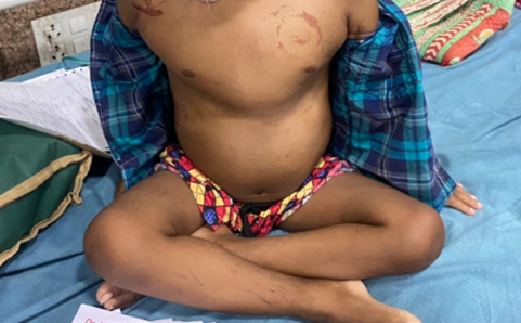 This image shows a child sitting cross-legged on a medical examination table. The child is partially undressed, with a plaid shirt open and colorful shorts visible. There are visible circular marks or bruises on the upper chest and shoulder, along with other faint skin markings on the arms and legs. The child's posture is relaxed, and medical documents can be seen in the background, suggesting a clinical or healthcare setting.