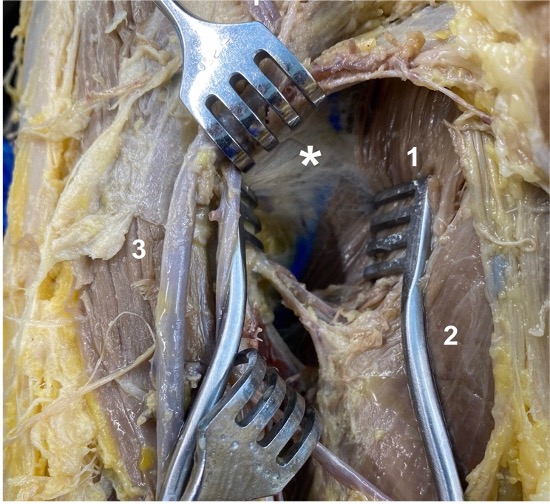 The image titled "Staining of the Iliopectineal Bursa" shows a dissection of the right femoral triangle in a formalin-fixed specimen. The iliopectineal bursa is marked with an asterisk (*), positioned deep to the psoas tendon and ventral to the pectineus muscle (1). The dissection is framed by the adductor longus muscle (2) and the sartorius muscle (3). This illustration highlights the use of ultrasound-guided techniques to inject blue latex into the bursa, which helps students visualize this otherwise difficult-to-dissect structure​.