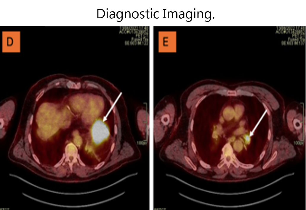 This image presents two axial slices from a positron emission tomography (PET) scan of the chest, labeled D and E. In image D, a white arrow points to a region of intense radiotracer uptake in the lower lobe of the right lung, suggesting a potentially active tumor lesion. In image E, the arrow indicates increased uptake in the mediastinal region, possibly corresponding to a mediastinal lymph node or metastatic site. These PET scan images are commonly used for diagnosing and staging oncologic diseases such as lung cancer.