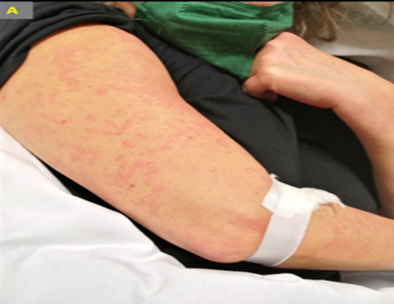The image shows the left arm of a patient with a diffuse, erythematous maculopapular rash, primarily involving the upper arm. The rash appears as multiple red spots and patches, consistent with a morbilliform eruption. A bandage is seen at the antecubital fossa, suggesting recent blood sampling or intravenous access. The clinical context may suggest a drug reaction, viral exanthem, or allergic response.