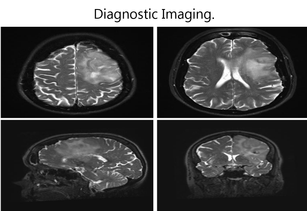 This image shows brain MRI scans in axial, sagittal, and coronal views. A large hyperintense lesion is observed in the right cerebral hemisphere, involving both cortical and subcortical regions, with mass effect and surrounding edema. These findings suggest a space-occupying lesion, such as a high-grade glioma or other intracranial tumor, and require further evaluation.