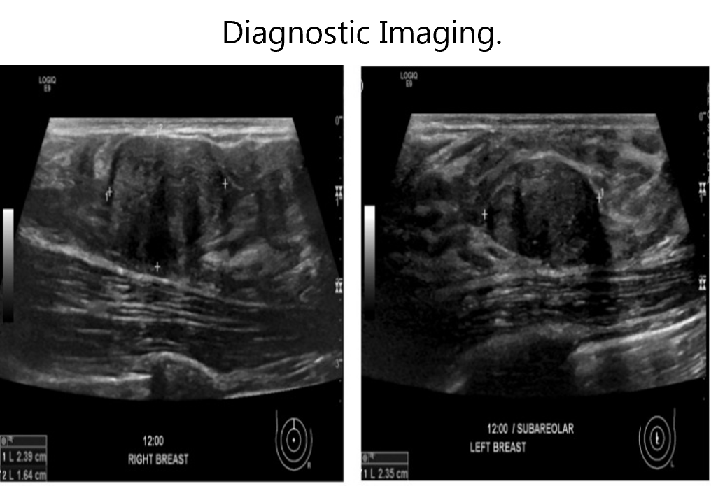 This image shows bilateral breast ultrasound scans. On the right breast (left panel), there is a hypoechoic irregular mass measuring approximately 2.39 x 1.64 cm, while on the left breast (right panel), a similar hypoechoic lesion is observed in the subareolar region measuring about 2.35 cm. These findings are suggestive of suspicious breast masses and require further evaluation with complementary imaging and/or biopsy.