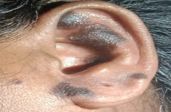 This image shows a close-up view of a human ear with multiple darkly pigmented patches on the auricle. The discoloration appears as irregular dark spots distributed over the outer ear, which may represent skin pigmentation changes, bruising, or a dermatological condition.