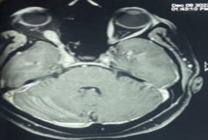 The image is an axial magnetic resonance (MR) scan of the brain, capturing the posterior fossa and the orbits. This transversal view clearly shows the cerebellar hemispheres and the brainstem centrally, along with both eyeballs and their extrinsic muscles. Based on the signal intensity, the sequence appears to be T1-weighted, possibly post-contrast or a fat-suppressed sequence. From this single snapshot, no large, obvious focal lesions are identified within the structures of the posterior fossa.