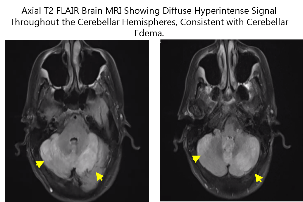 This image shows two axial brain MRI scans with contrast. The yellow arrows point to abnormal hyperintense areas in the cerebellum, suggesting bilateral cerebellar lesions. These findings may represent edema, demyelination, ischemia, or other pathological processes affecting the posterior fossa.