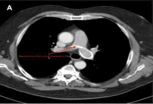 This image shows a computed tomography (CT) scan of a patient's chest in an axial view, highlighting a specific vascular finding. An orange arrow points toward a hyperdense metallic fragment located within the pulmonary artery (PA), likely representing a foreign body or medical material that has migrated or been deposited there. The scan provides a clear transverse cross-section of the thoracic cavity, allowing for the visualization of the heart, major blood vessels, and lungs surrounding the central point of interest.