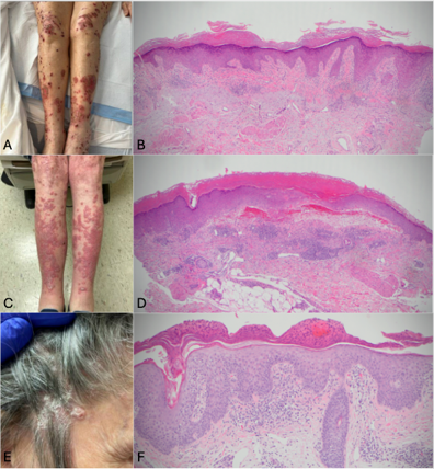 Composite clinical and histopathology image showing multiple erythematous, crusted skin lesions on both lower legs and scalp (panels A, C, E), alongside corresponding hematoxylin and eosin–stained skin biopsy sections (panels B, D, F) demonstrating epidermal and dermal inflammatory changes.