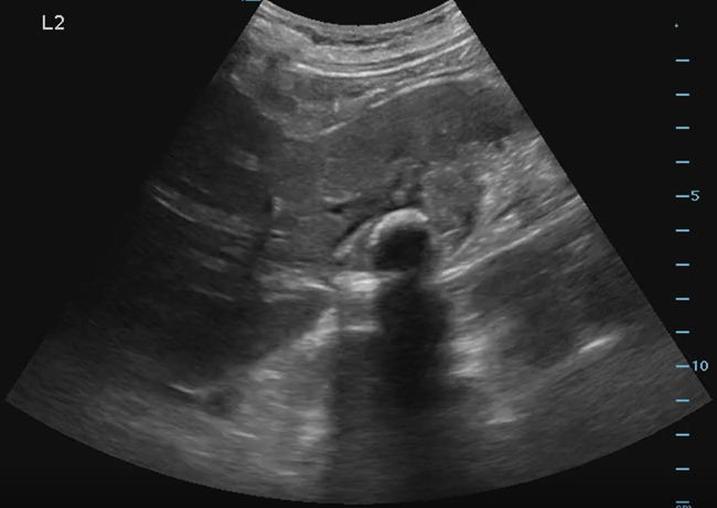 Gallbladder Bedside Ultrasound Examination