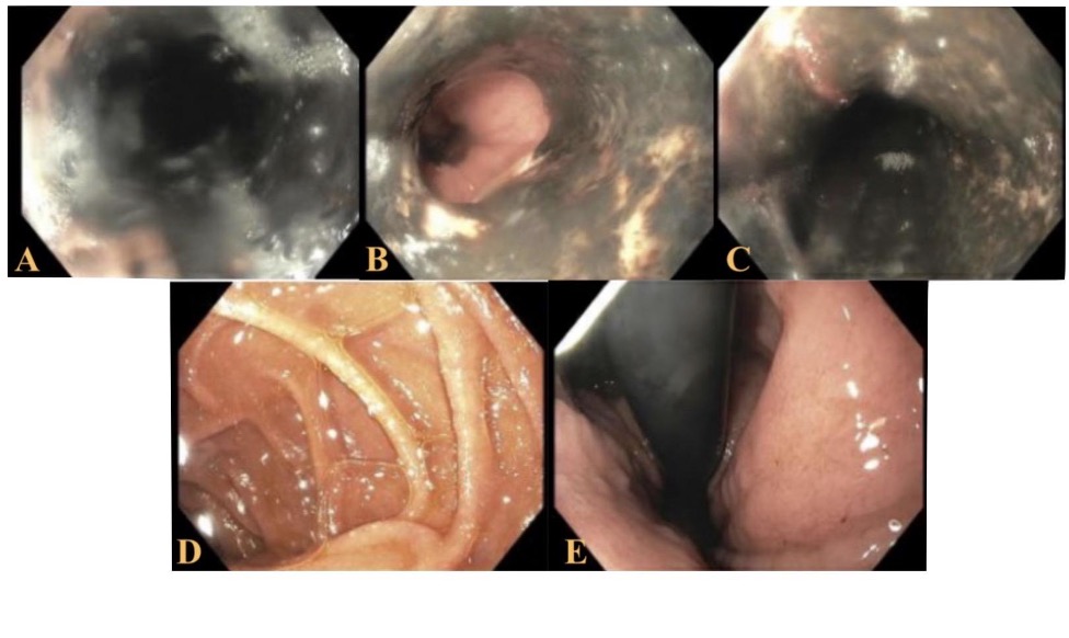Fig. A, B, C: Middle, distal, and proximal esophagus showing esophageal necrosis; D: Second part of duodenum showing distinct, well-defined circular folds (Kerckring's folds); E: Pinkish greater curvature of stomach without any signs of necrosis.