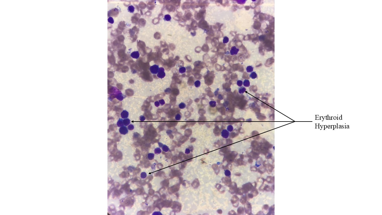 Figure 1: Depicts erythroid hyperplasia in the Bone Marrow aspirate